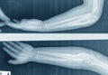 x-ray elbow Ã¢â¬â¹Lateral, AP view of the forearm caused by bone cancerosteosarcoma of the ulna. Isolated on black