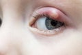 Close up right upper eye lid abscess, stye or hordeolum Royalty Free Stock Photo