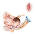 Childbirth - Normal Vaginal Birth