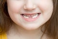 Childish face lower part with missing front lower milk teeth in a smiling mouth Royalty Free Stock Photo