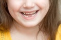 Childish face lower part with missing front lower milk teeth in a smiling mouth Royalty Free Stock Photo