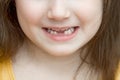 Childish face lower part with missing front lower milk teeth in a smiling mouth Royalty Free Stock Photo