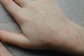 Children hand with atopic dermatitis. eczema on hand. psoriasis on kids hands Royalty Free Stock Photo