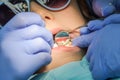 Children`s dentist treats baby teeth