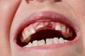 Children`s milk teeth. Adult teeth grow from the top to the front Royalty Free Stock Photo