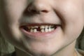 Children`s mouth with fallen and broken milk teeth Royalty Free Stock Photo