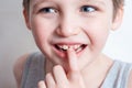 Children`s teeth, loss and fingers pointed at the incisor teeth, children`s mouths of child close up, incisor milk tooth missing