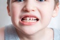 Children`s teeth, loss and fingers pointed at the incisor teeth, children`s mouths of child close up, incisor milk tooth missing Royalty Free Stock Photo