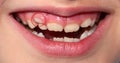 Children`s teeth. The molar grows in the second row. Anomalies of tooth growth