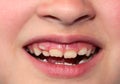 Children`s teeth. The molar grows in the second row. Anomalies of tooth growth