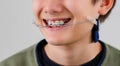 Closeup children boy wearing orthodontic appliance treatment. Dental braces with child concept.