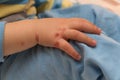 Childrens hand with skin disease