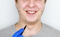 Chin lift - mentoplasty. A man at the reception at the plastic surgeon. Preparation for surgery Royalty Free Stock Photo