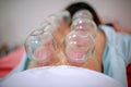 Chinese medicine science is a method of treatment using Cupping. Royalty Free Stock Photo