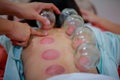 Chinese medicine science is a method of treatment using Cupping. Royalty Free Stock Photo