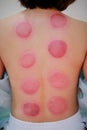 Chinese medicine science is a method of treatment using Cupping.