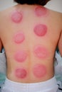 Chinese medicine science is a method of treatment using Cupping. Royalty Free Stock Photo