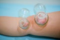 Chinese medicine science is a method of treatment using Cupping. Royalty Free Stock Photo