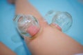 Chinese medicine science is a method of treatment using Cupping.