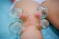 Chinese medicine science is a method of treatment using Cupping. Royalty Free Stock Photo