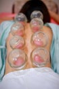 Chinese medicine science is a method of treatment using Cupping Therapy to heat the air in the air and then close the flow of the Royalty Free Stock Photo