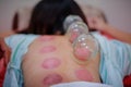 Chinese medicine science is a method of treatment using Cupping Therapy to heat the air in the air and then close the flow of the Royalty Free Stock Photo