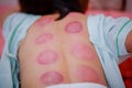 Chinese medicine science is a method of treatment using Cupping. Royalty Free Stock Photo