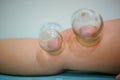 Chinese medicine science is a method of treatment using Cupping.