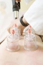 Chinese Traditional Cupping Therapy For Improved Circulation Royalty Free Stock Photo