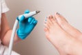 Chiropodist holding a handle of hardware peeling. Close up of female feet with ingrown toenails. The concept of
