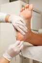 Chiropodist removes skin on a wart