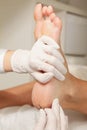 Chiropodist removes skin on a wart with Royalty Free Stock Photo