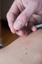 Chiropractor acupuncture needle of female patient Royalty Free Stock Photo