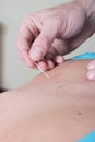 Chiropractor using acupuncture needle on patient Royalty Free Stock Photo