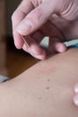 Chiropractor using acupuncture needle target area Royalty Free Stock Photo