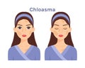 Chloasma. Beautiful face and Skin disease.Treatment.Woman with open eyes and closed.