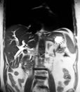 Cholangiogram gallbladder stones cholecystosis mri