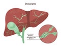 Cholangitis or ascending cholangitis. Infection and imflamation