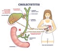 Cholecystitis as gallbladder inflammation from gallbladder outline diagram