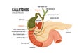 Cholelithiasis, cholecystitis. Formations in the gallbladder. Blockage of the bile duct. Pancreas. Royalty Free Stock Photo
