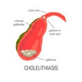 Inflamed gallbladder, cholelithiasis concept