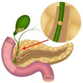 cholelithiasis. Formations in the gallbladder.