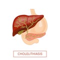 Cholelithiasis - gallstone disease