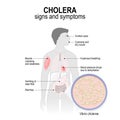 Cholera. Signs and symptoms. Royalty Free Stock Photo