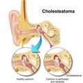 Cholesteatoma human ear anatomy  illustraton on white background Royalty Free Stock Photo