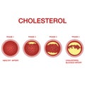 Cholesterol in the arteries.The accumulation of cholesterol in the blood vessels. Atherosclerosis Royalty Free Stock Photo