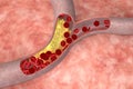 Cholesterol in artery