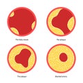 Cholesterol and atherosclerosis