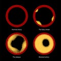 Cholesterol and atherosclerosis