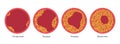 Cholesterol and atherosclerosis